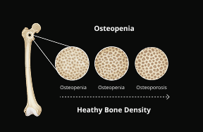 Bone Mineral Density Assessment